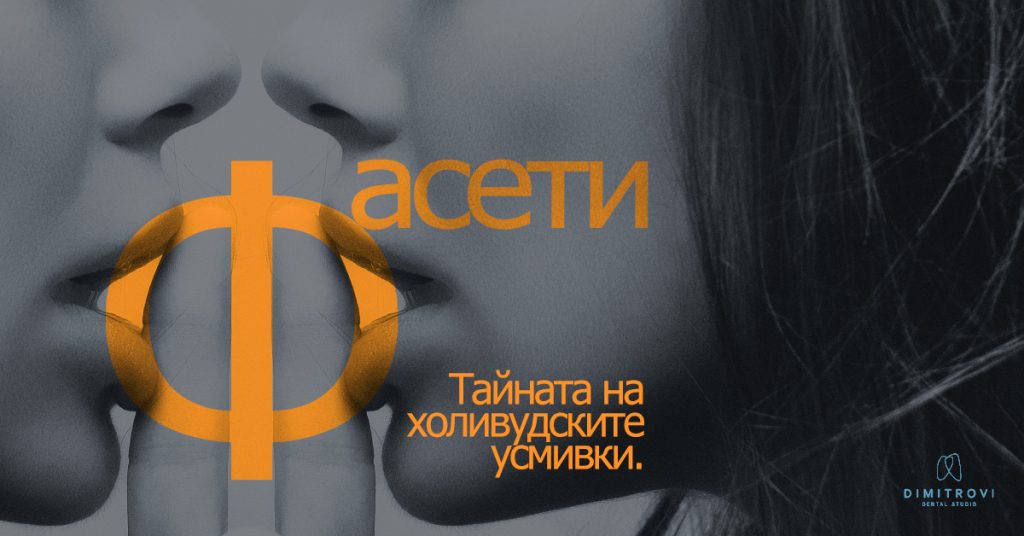 Фасети – тайната на холивудските усмивки